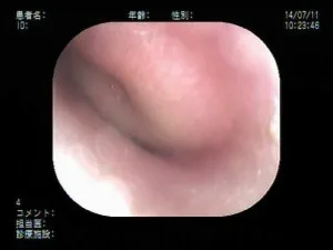 膿がたまっている鼓膜