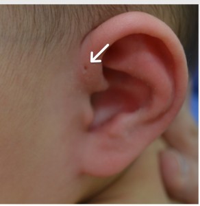 耳瘻孔の写真