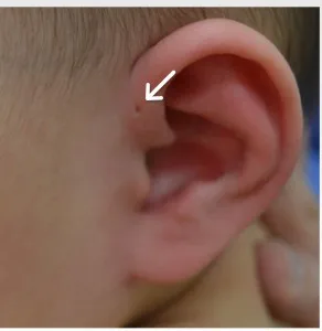 先天性耳瘻孔 ミルディス小児科耳鼻科