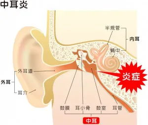 急性中耳炎 ミルディス小児科耳鼻科