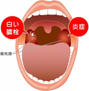 足立区北千住で扁桃炎・扁桃腺の治療ならミルディス小児科耳鼻科